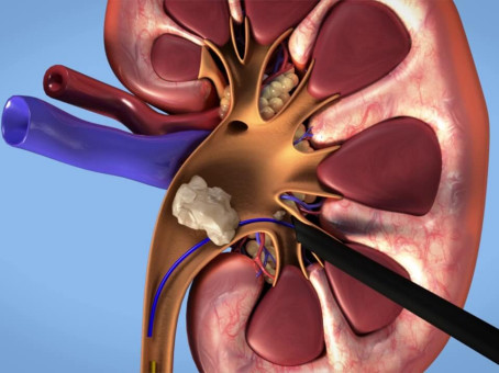 Какой продукт ведет к камням в почках и истончению костей